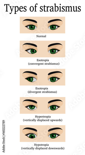 Types of strabismus