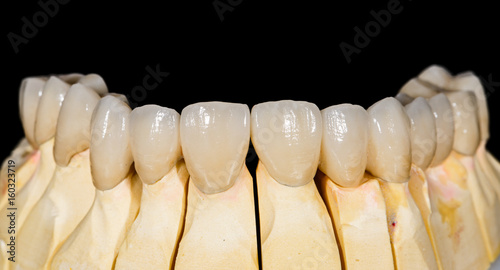 Obraz na płótnie Dental ceramic bridge