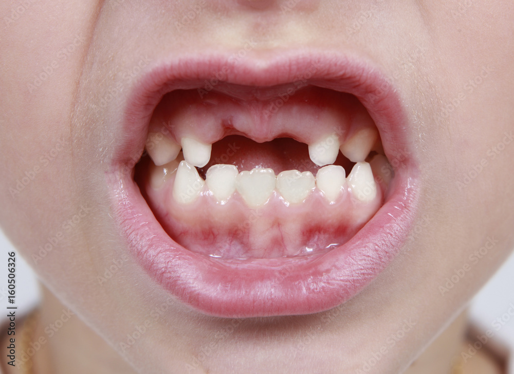 Fototapeta premium Closeup of child's month with missing teeth