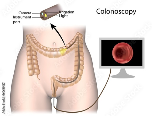 Colonoscopy procedure
