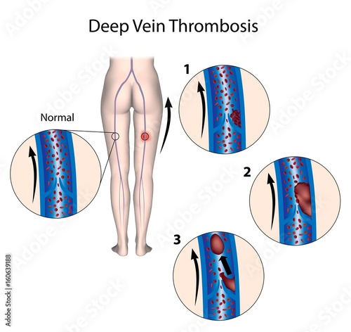 Deep vein thrombosis