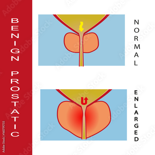 Benign prostatic hyperplasia, vector illustration (for basic medical education, for clinics & Schools)