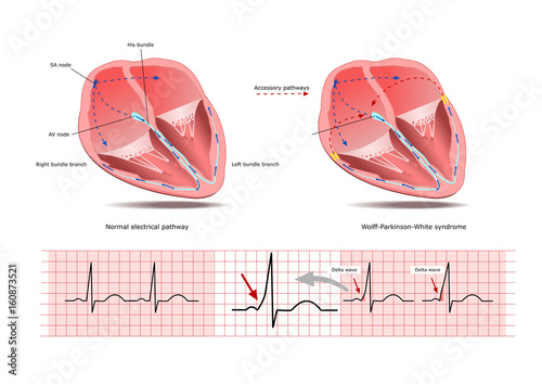 The Wolff-Parkinson-White (WPW) syndrome, a condition of altered electrical signaling, and two electrocardigrams showing the differencese (delta wave).
