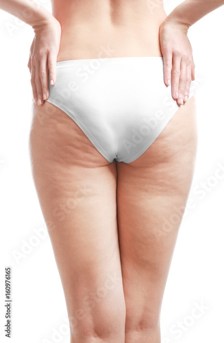 Obraz na płótnie Woman with cellulite problem on white background