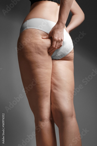 Obraz na płótnie Woman with cellulite problem on dark background