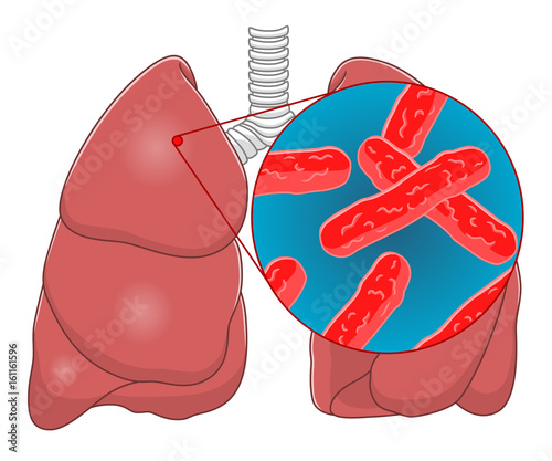 Tuberculosis