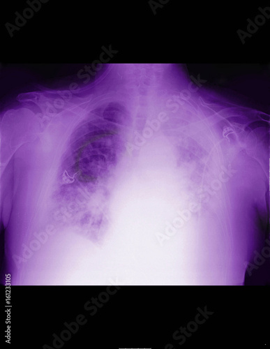 X-ray of lung with mesothelioma photo