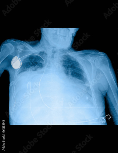 X-ray showing dyspnea in chest