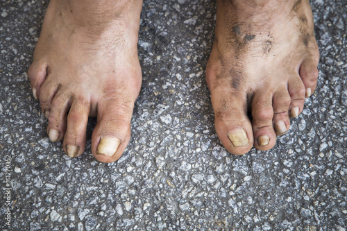 Feet of a human being who lives on the street.