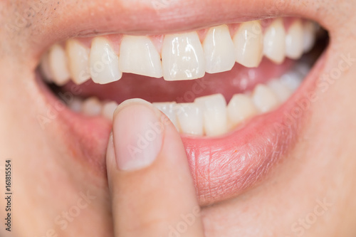 Fototapeta Naklejka Na Ścianę i Meble -  ugly smile dental problem. Teeth Injuries or Teeth Breaking in Male. Trauma and Nerve Damage of injured tooth, Permanent Teeth Injury.