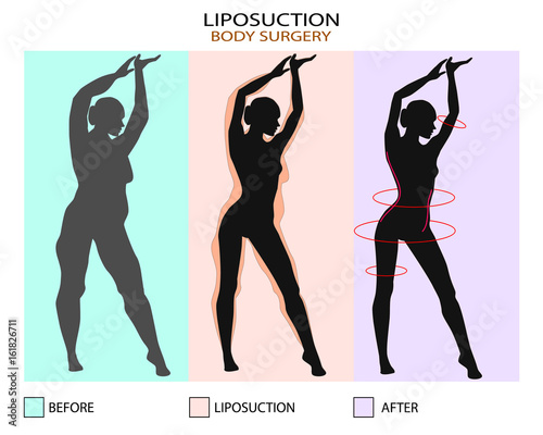 Liposuction before and after. Plastic surgery infographic of Aesthetic Procedures