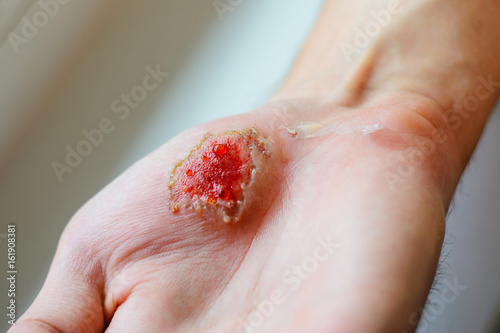 Deep abrasion in the palm of the person. Medical background