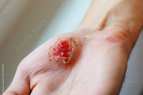 Deep abrasion in the palm of the person. Medical background