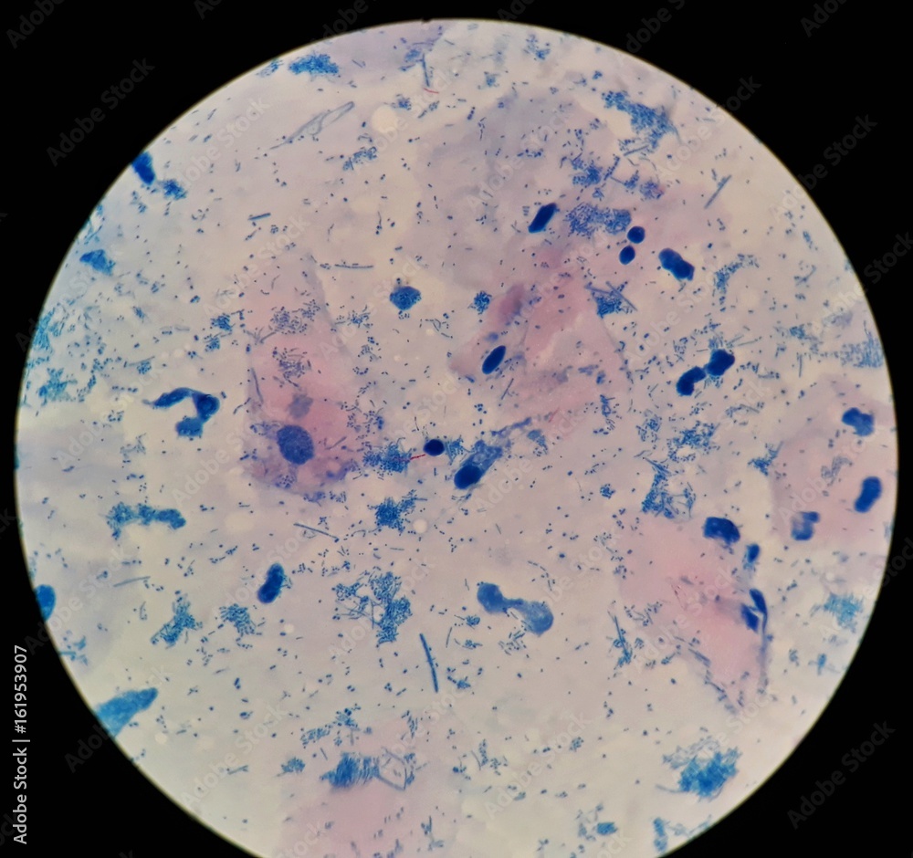 Smear of Acid-Fast bacilli (AFB) stained from sputum specimen with positive  Mycobacterium tuberculosis (MTB) and many types of bacteria, under 100X light  microscope and selective focus. Stock Photo | Adobe Stock