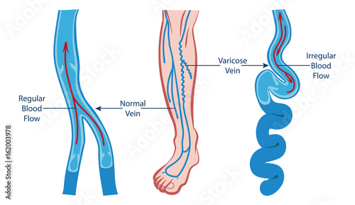 VARICOSE VEIN AND NORMAL VEIN ILLUSTRATION VECTOR