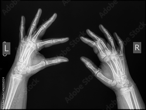 film x-rays of human hands oblique view