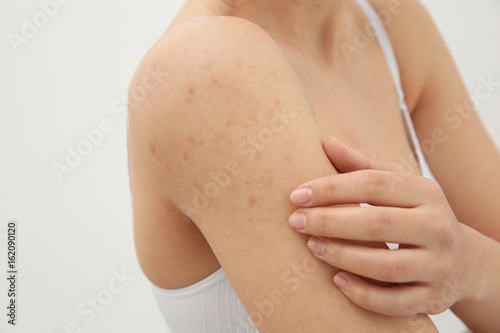 Allergy concept. Woman scratching her shoulder with rash on white background photo