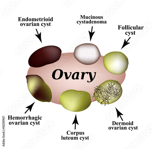 Types of ovarian cysts. Set. Infographics. Vector illustration on isolated background.