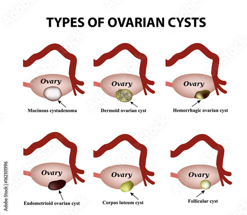 Types of ovarian cysts. Set. Infographics. Vector illustration on isolated background