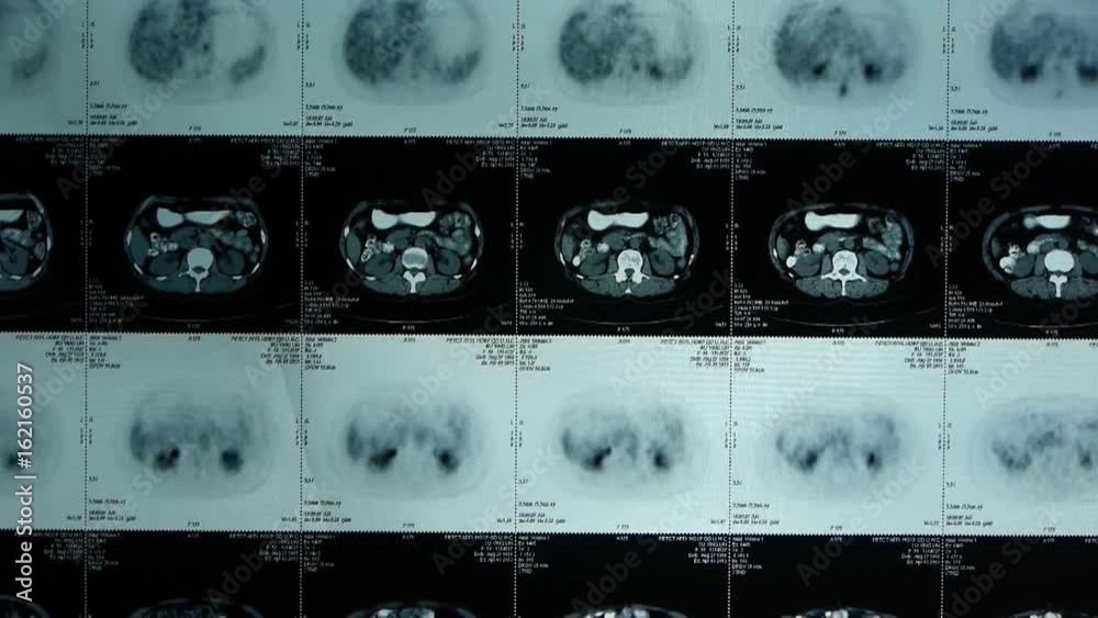 moving human organ pet-ct scan,lymph nodes X-ray,Cancer metastasis ...