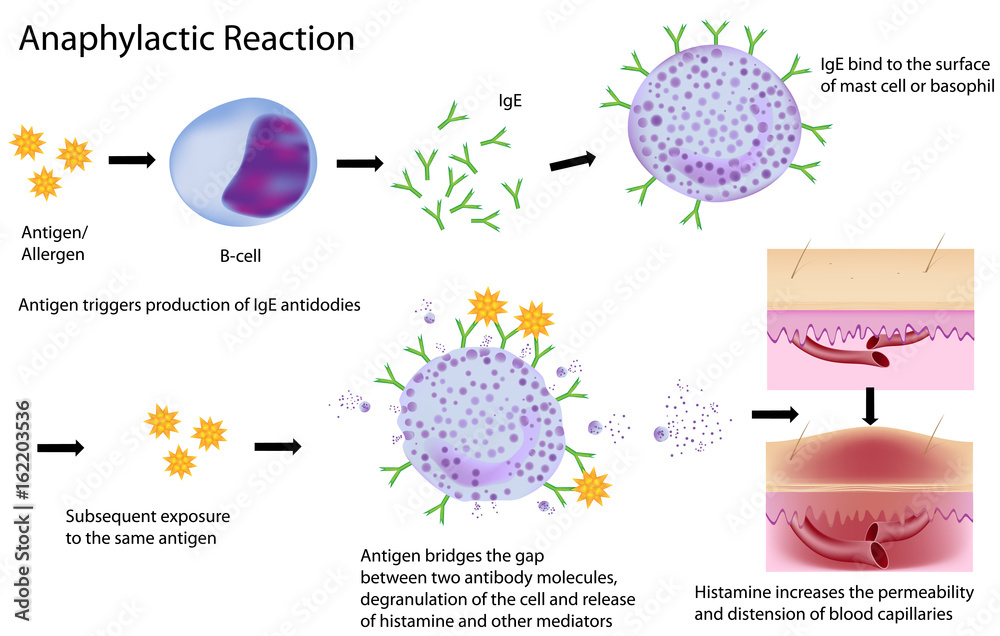 Mechanism of allergy (drug,hay fever, asthma,. Stock Illustration