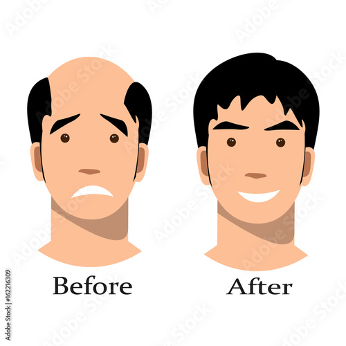 Male baldness pattern stages set.