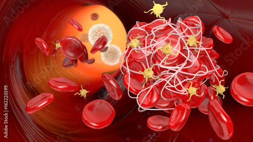 Thrombus in bloodstream, blood-clot with activated platelets and fibrin, medical illustration photo