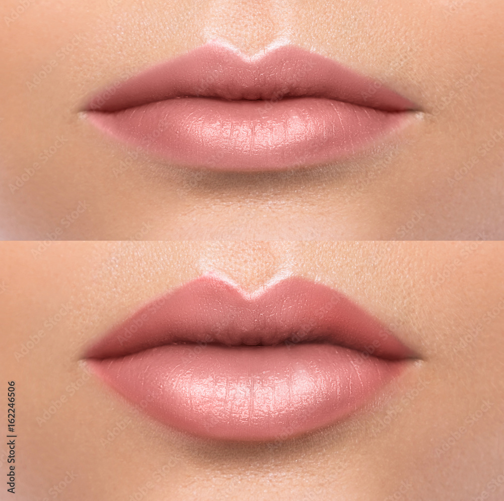 Fototapeta premium Comparison of female lips after augmentation