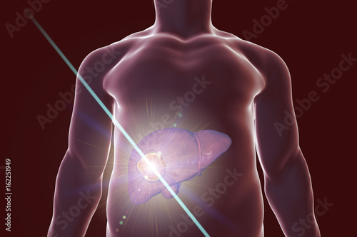 Liver cancer treatment with laser. Conceptual image. 3D illustration photo