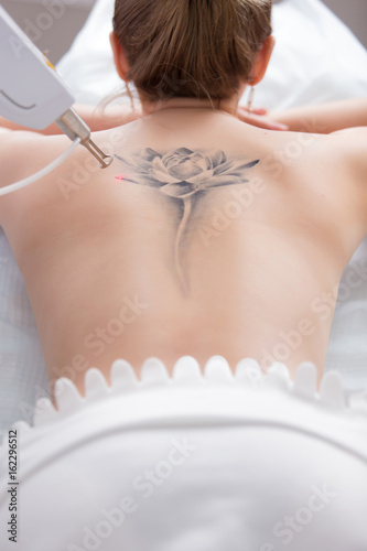 laser tattoo removal