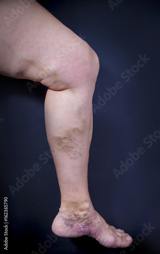 Human leg with varicose veins