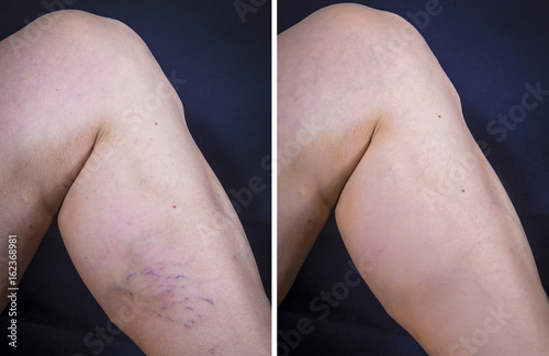 Human leg with varicose veins before and after treatment
