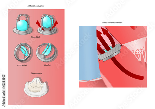 Main types of artificial heart valves, a bioprosthesis, and an aortic valve replacement
