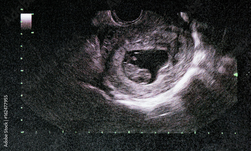 An ultrasound of a human fetus during the 14 week. photo