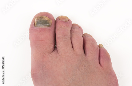 Sick nail on the leg, fungus on the big toe