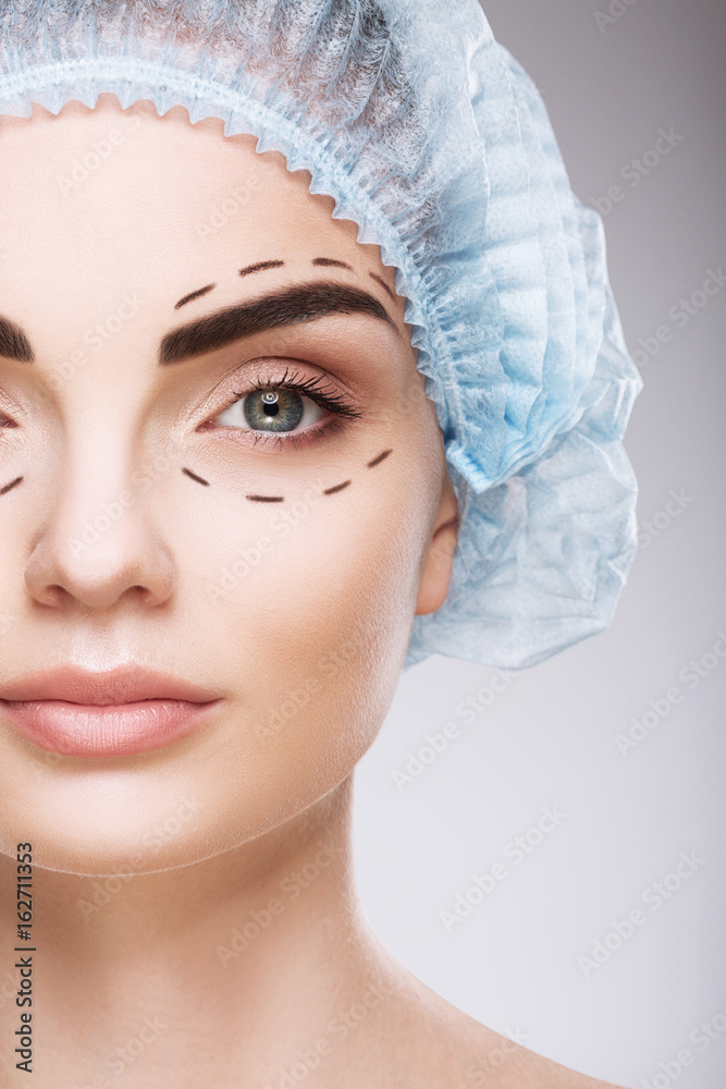 Perforation lines on patient's face Perforation lines on patient's face