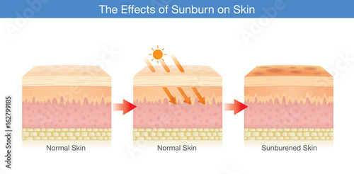 Step of Changing of human skin layer damaged from sunlight. Illustration about Health care.