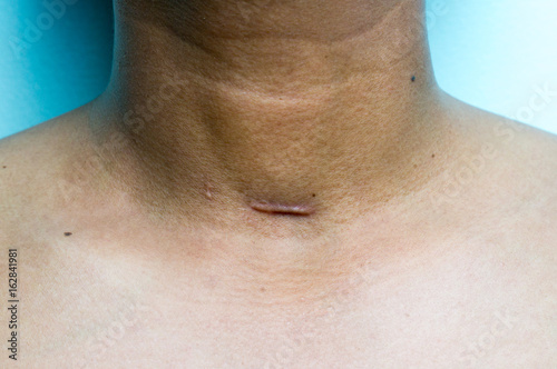 Tracheostomy Scar on male patient neck after operation.