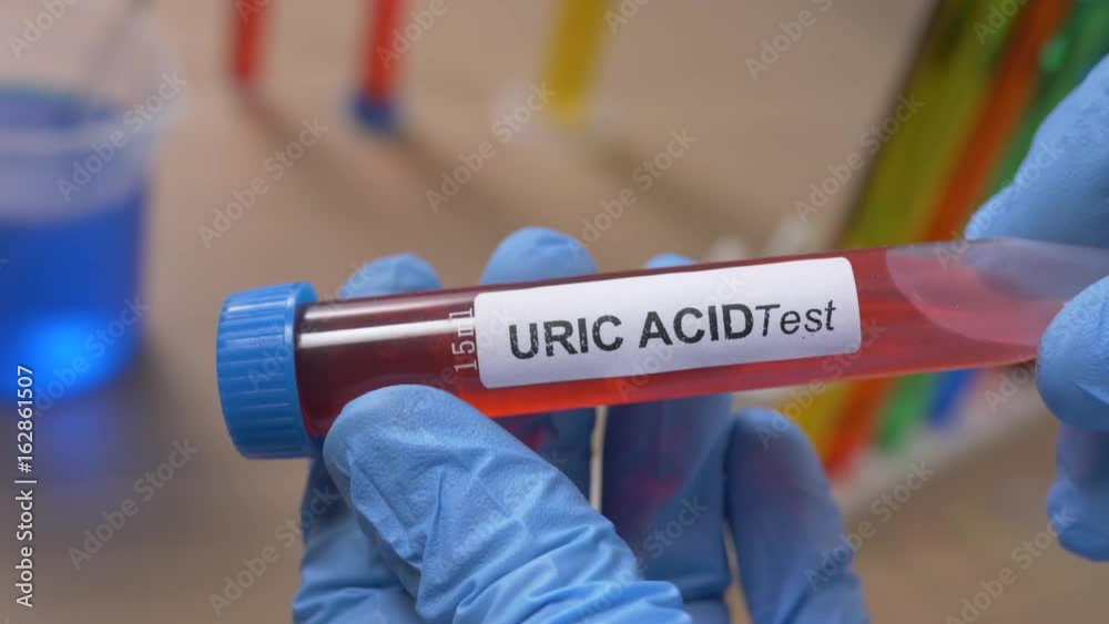 Vidéo Stock Scientist holding a uric acid test tube filled with a red