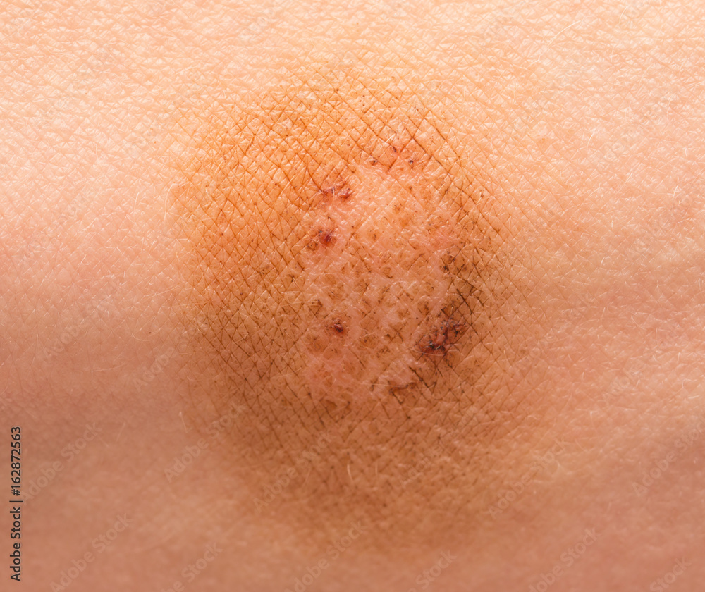 Ringworm on the skin Ringworm on the skin