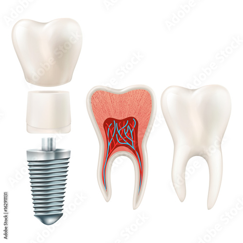 Dental implant set. EPS 10