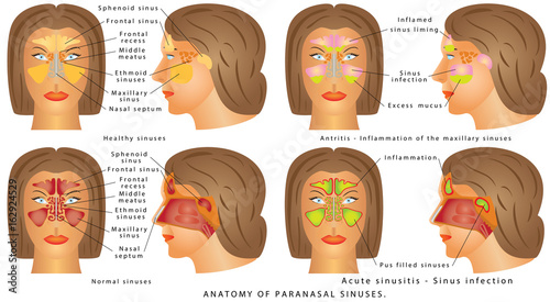 Nasal sinus/ Nasal sinus. Human Anatomy - Sinus Diagram. Anatomy of the Nose. Nasal cavity bones. Anatomy of paranasal sinuses. Sinusitis - Antritis - It is the inflammation of the maxillary sinuses