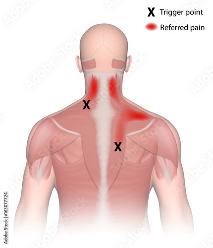 Obraz na płótnie Trigger points and referred pain