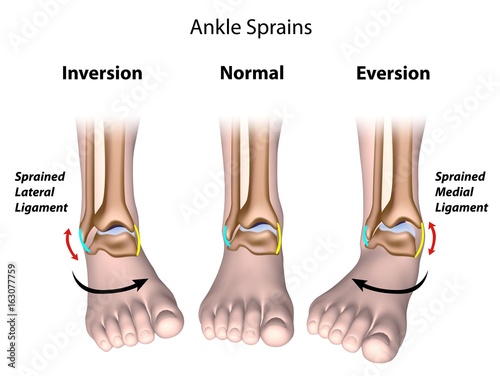 Types of ankle sprains photo