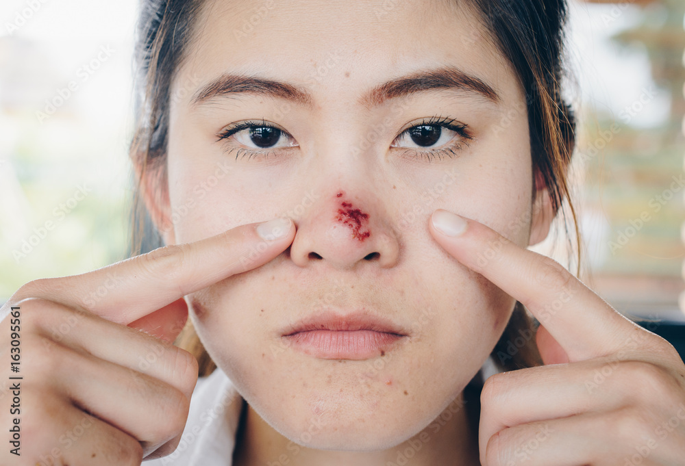 The Herpes simplex on asian woman nose, Herpes simplex is a viral