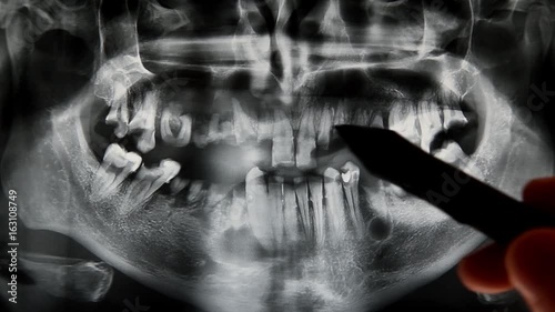 Dental X ray with bad teeth