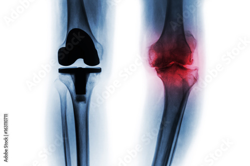 Film x-ray of osteoarthritis knee patient and artificial joint ( Total knee replacement ) . Isolated background . photo