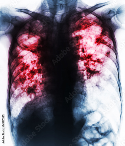 Pulmonary Tuberculosis . Film chest x-ray show fibrosis,cavity,interstitial infiltration both lung due to Mycobacterium tuberculosis infection . photo