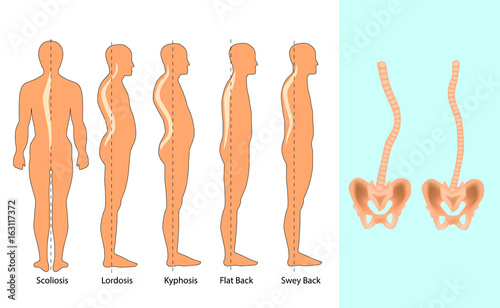 Spine deformation. Body posture defect. 