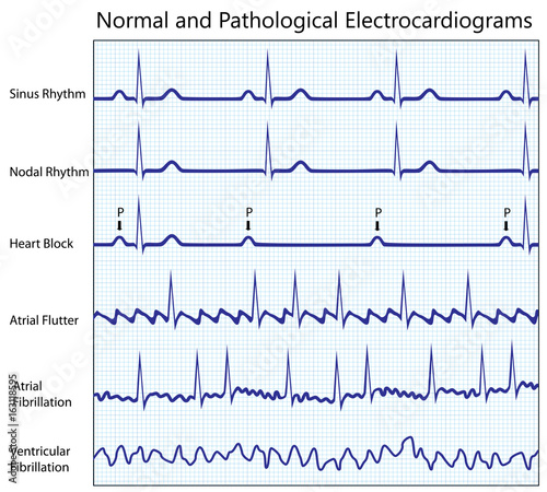 Normal and diseased ecg collection